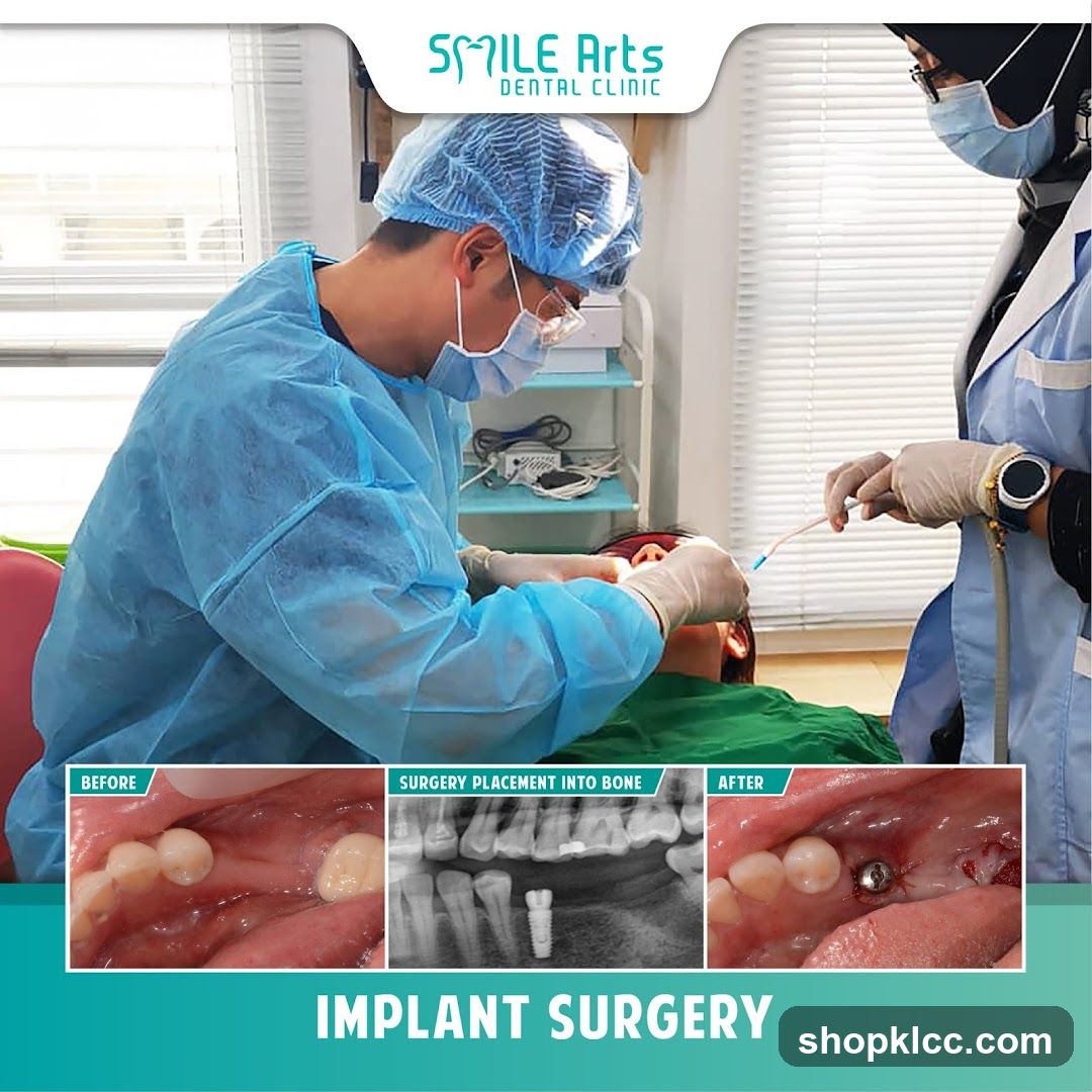 Implant Surgery