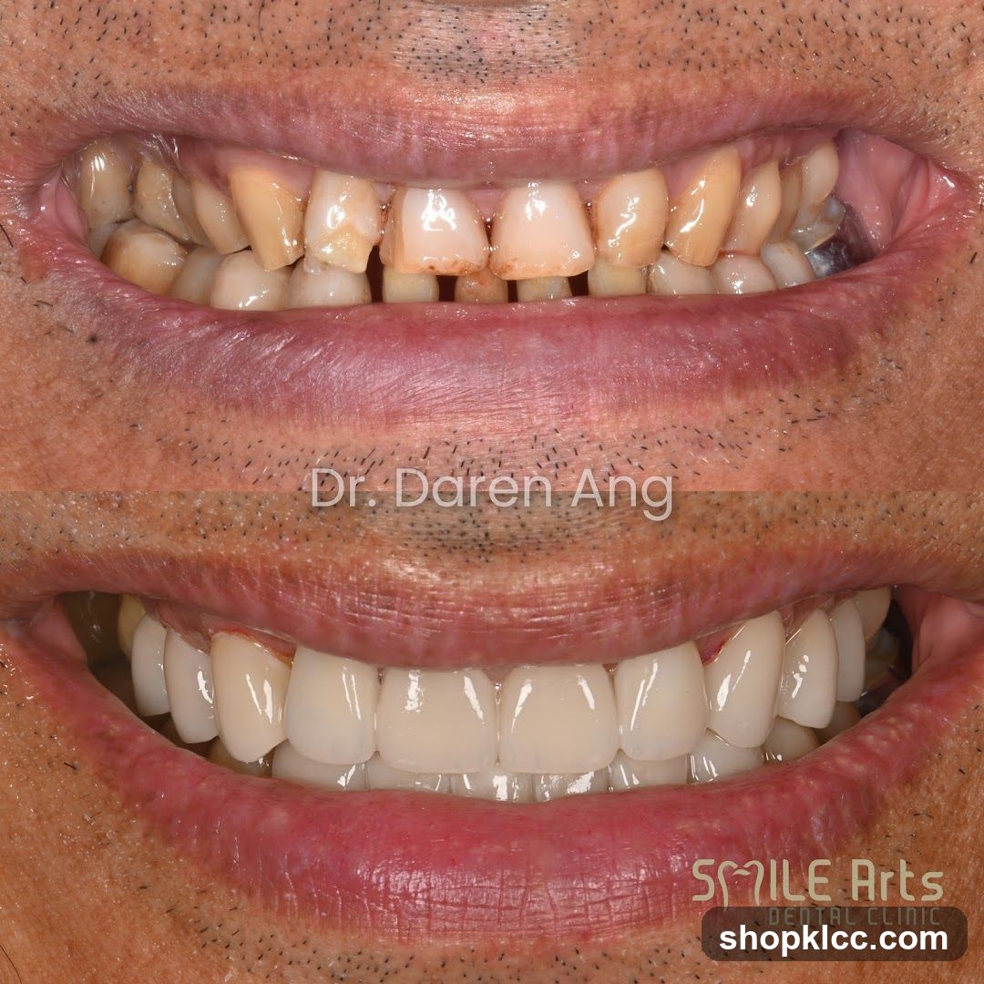 Dental Before and After Smile Transformation