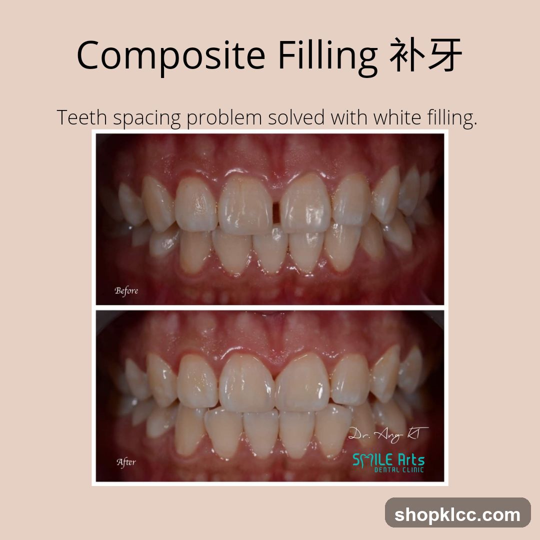 Composite Filling 补牙