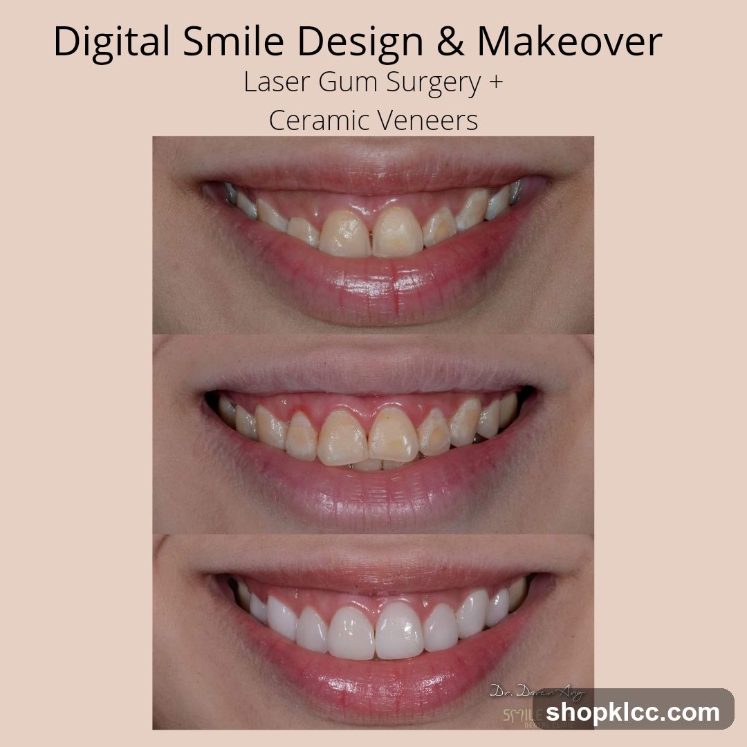 Digital Smile Design & Makeover