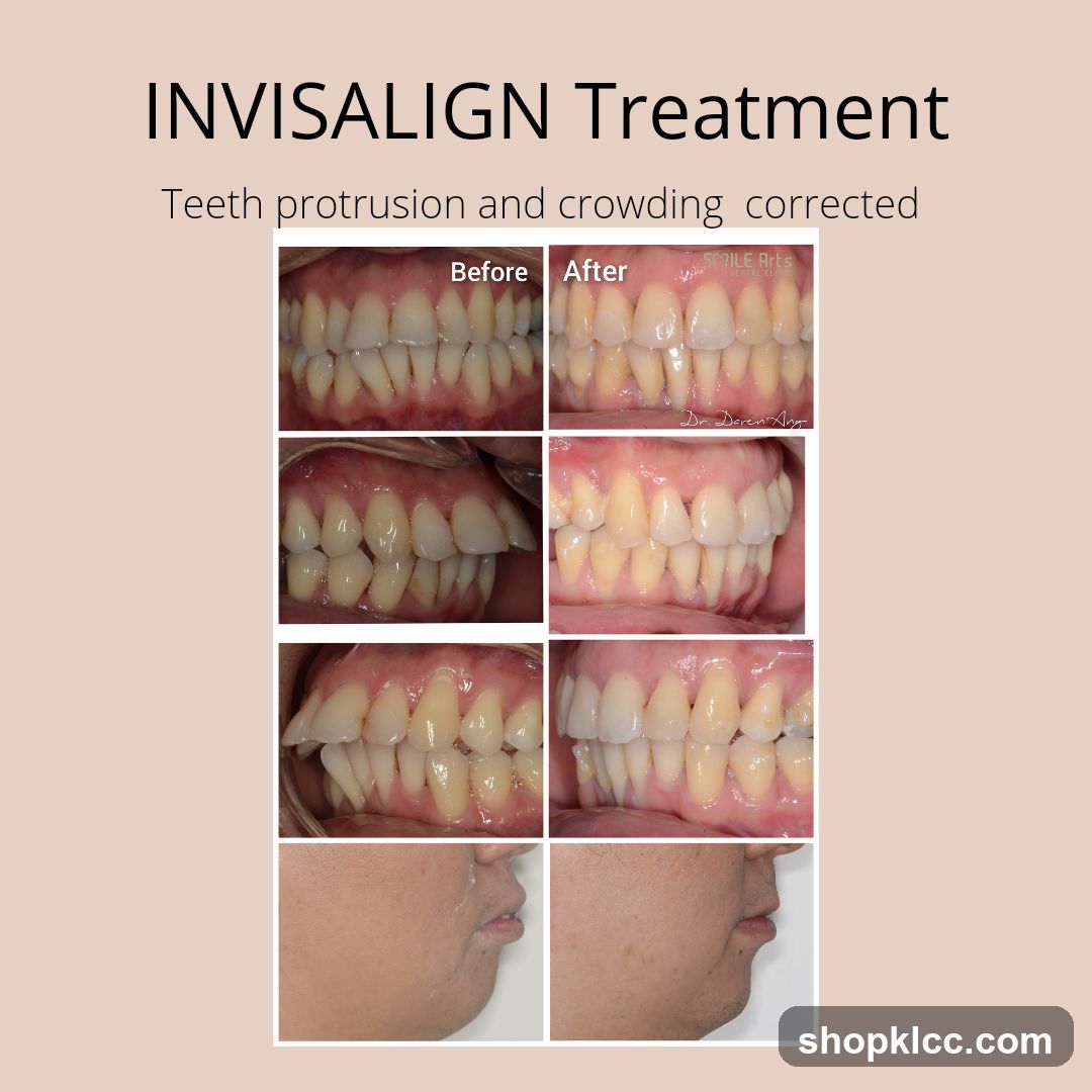 INVISALIGN Treatment
