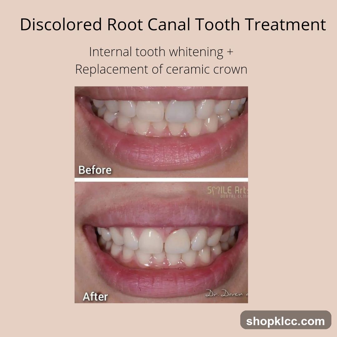 Discolored Root Canal Tooth Treatment