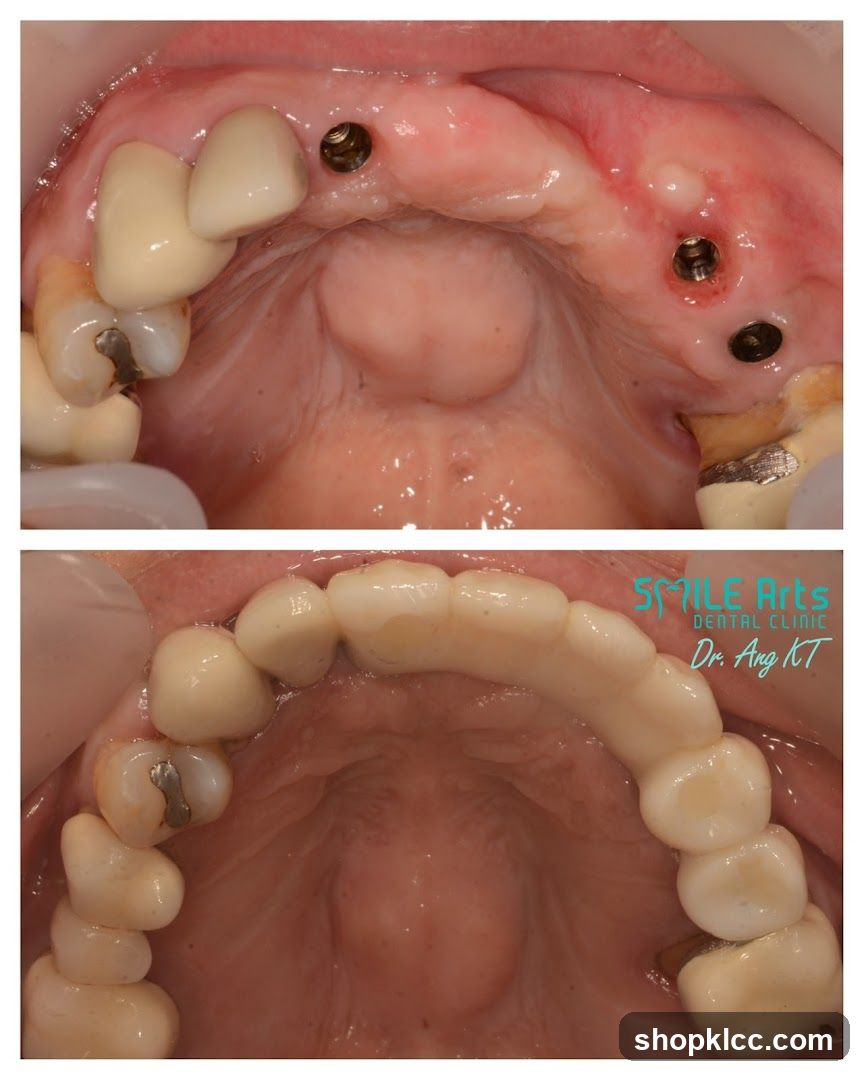 Dental Implant and Prosthesis Case