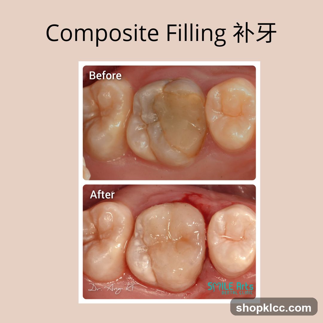 Composite Filling 补牙