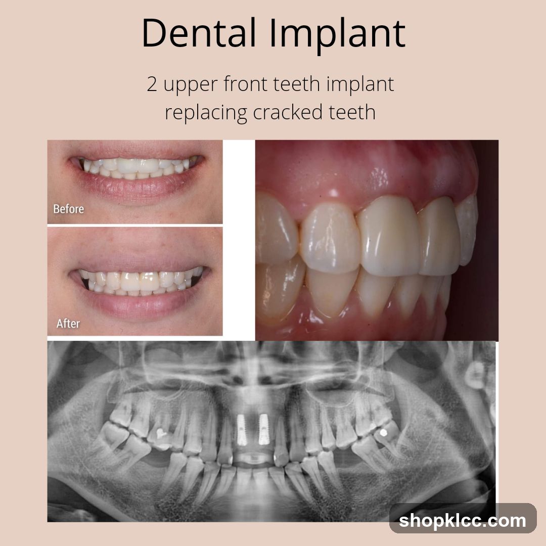 Dental Implant