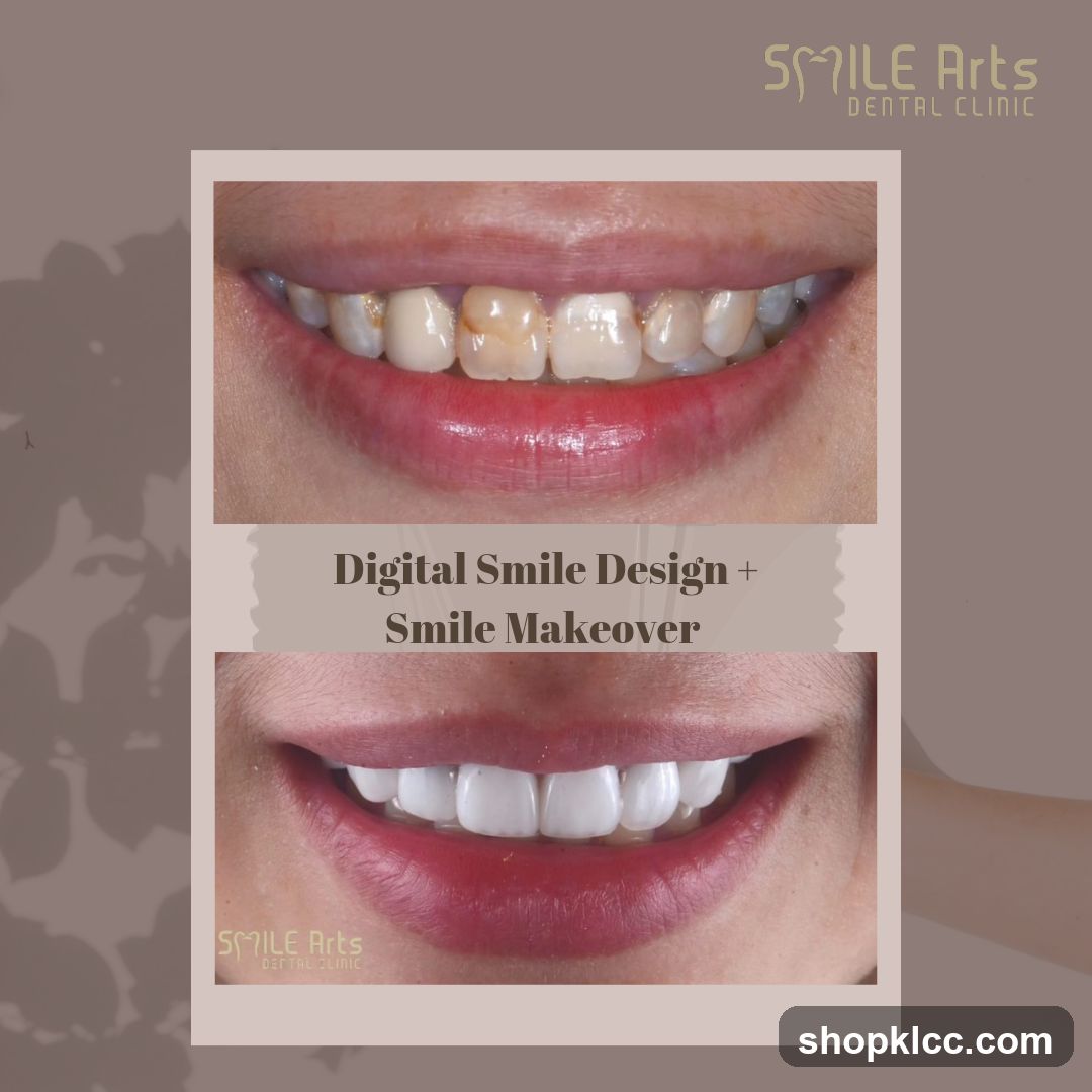Digital Smile Design + Smile Makeover