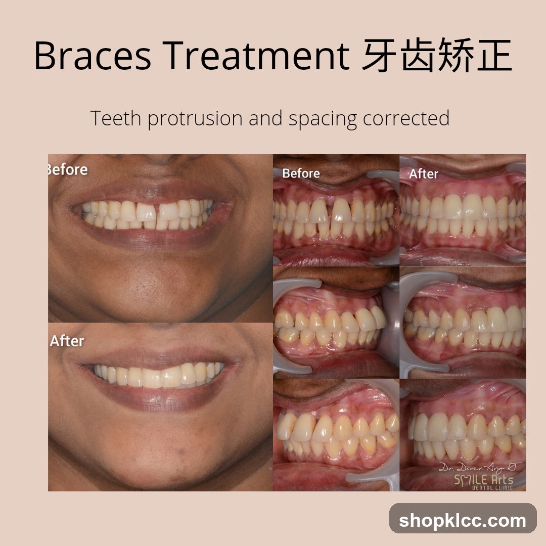 Braces Treatment 牙齿矫正