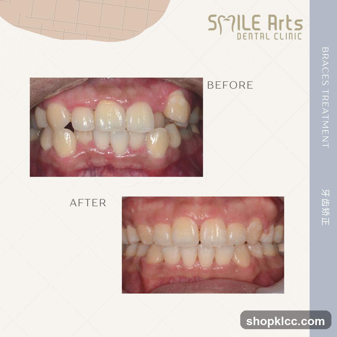 Smile Arts Dental Clinic - Braces Treatment Before and After