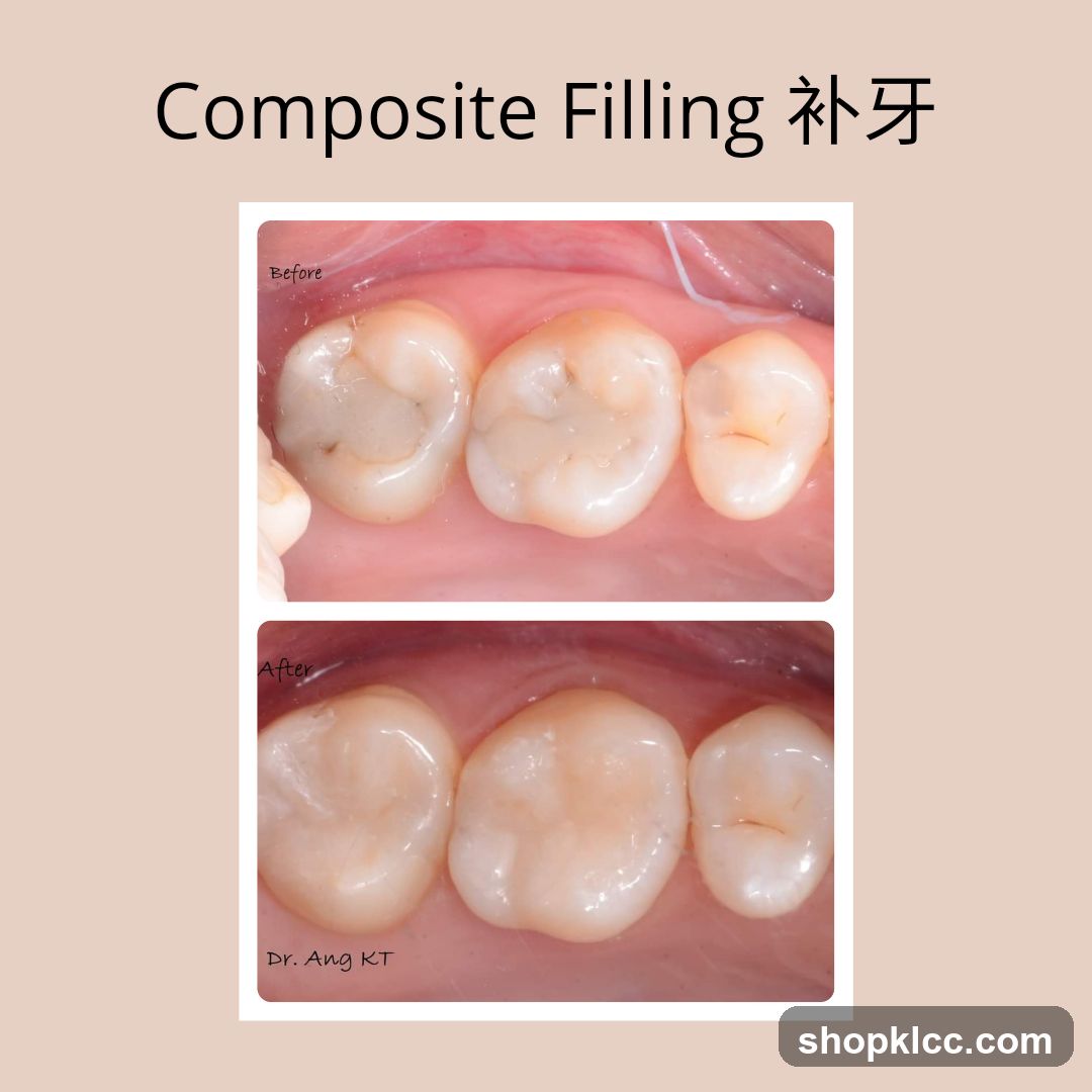 Composite Filling 补牙